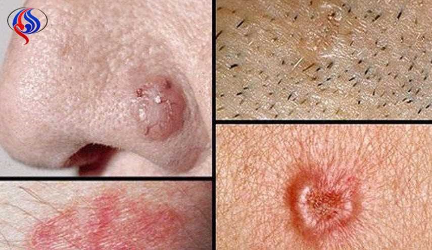 إذا لاحظتم هذه الإشارات فهي إشارة على الإصابة بالسرطان!