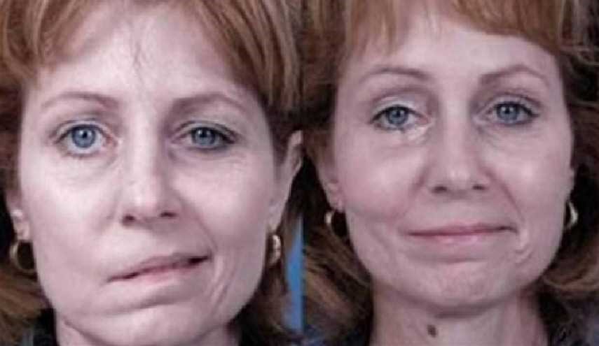 حذار.. هذا ما يعنيه تدلّي زاوية الفم فجأة!