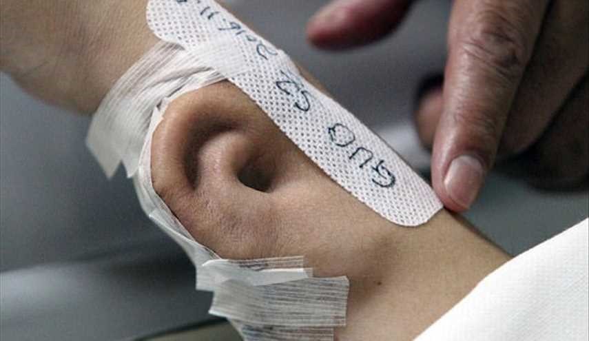 بالصور.. زراعة أذن في يد رجل صيني !! ... والسبب؟