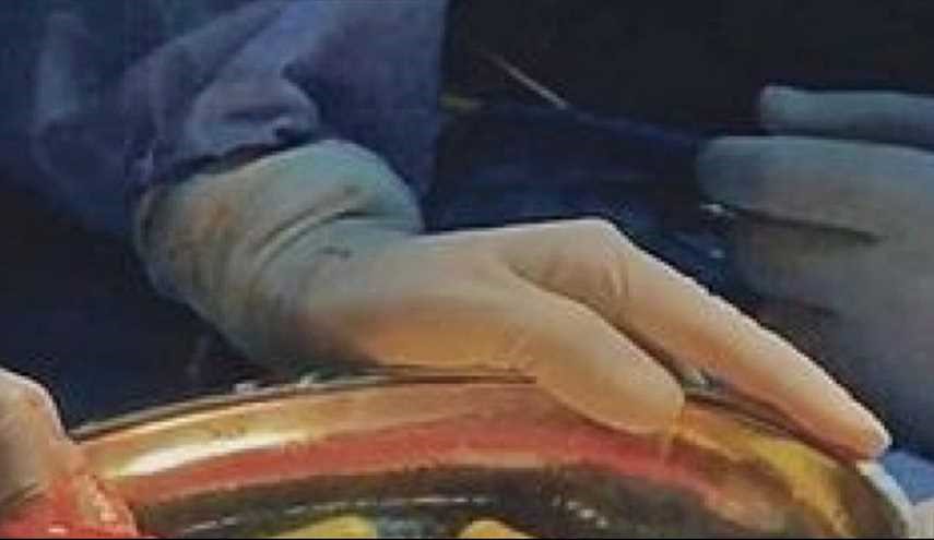 ينقذ من الموت المحتوم بعد الكشف كبسولات «هيروين» قبل انفجارها في أحشائه