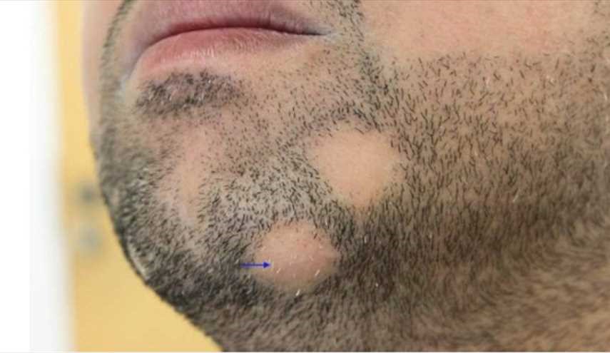 7 نصائح من أجل التخلص من فراغات الرأس و الذقن