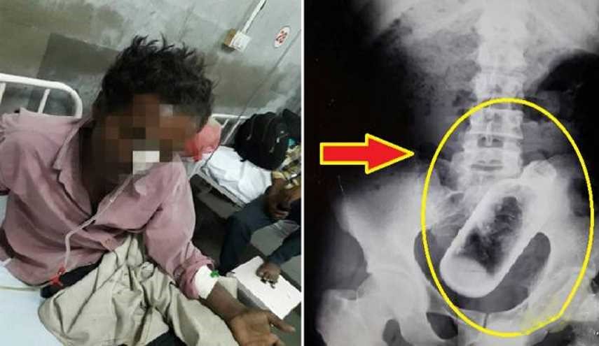 عاني من آلام في المعدة وأسفل الظهر.. وعند الذهاب للطبيب كانت الصاعقة!
