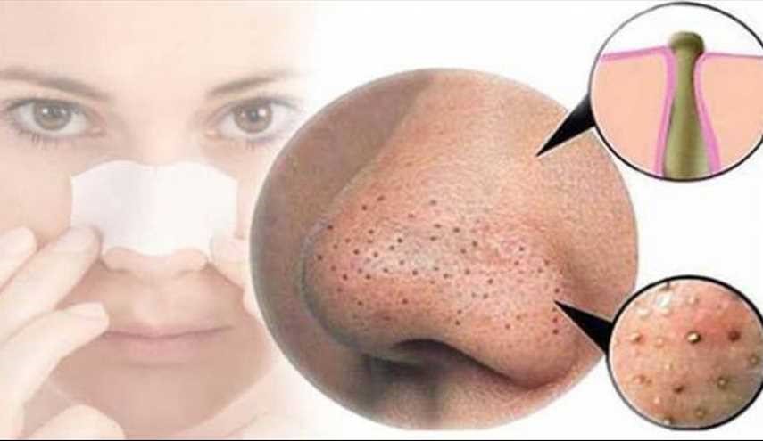 نعم، بإمكانكِ التخلّص من الرؤوس السوداء مع هذه المكوّنات!