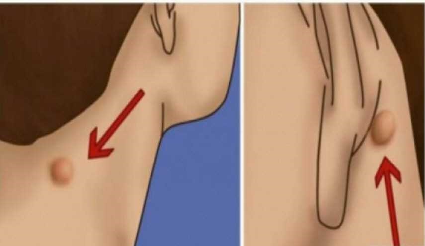هل لديك انتفاخ كهذا على رقبتك، ظهرك، أو خلف أذنك؟.. هذا ما عليك فعله!