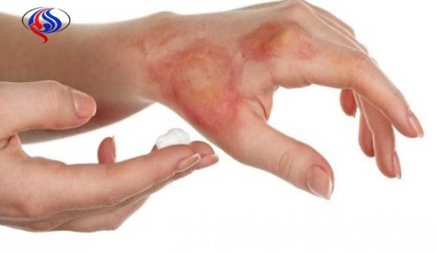 عشبة موجودة بكل منزل تخلّصكم من آثار الحروق بـ10 دقائق!