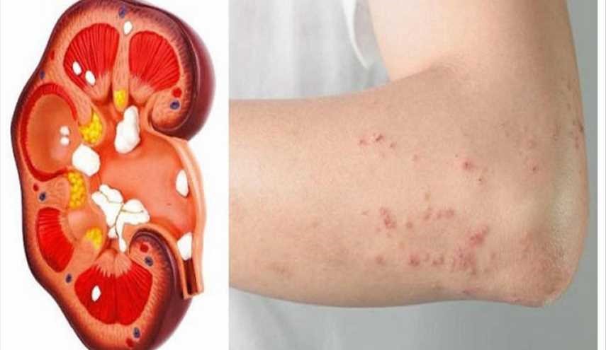 عندما تكون كليتاكم في خطر.. سيعطيكم الجسم 6 علامات بذلك