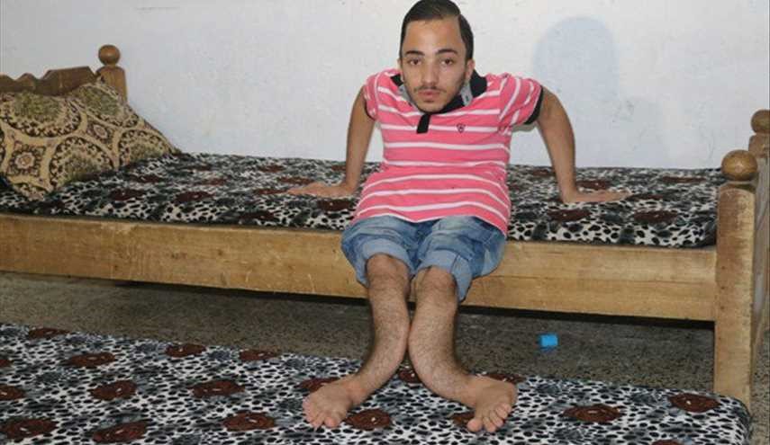 بالصور.. شاب بعظام مقوسة يناشد العبادي لمساعدته