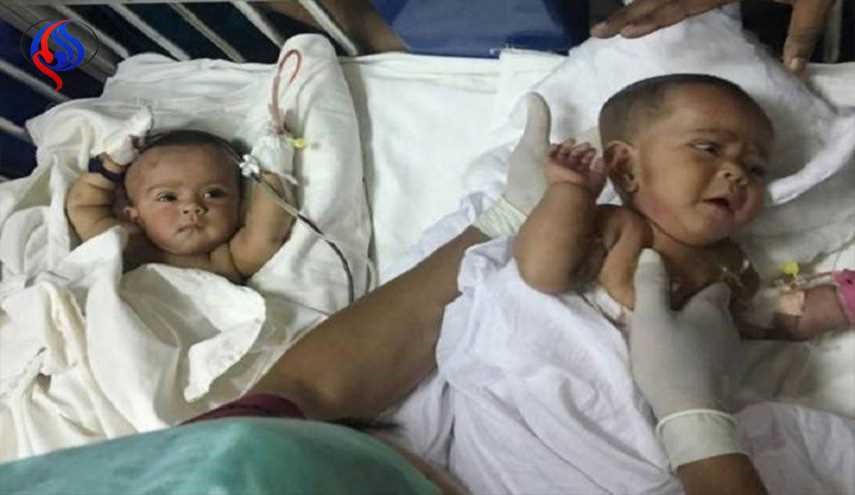 أول عملية ناجحة لفصل توأمين سياميين في بنغلاديش