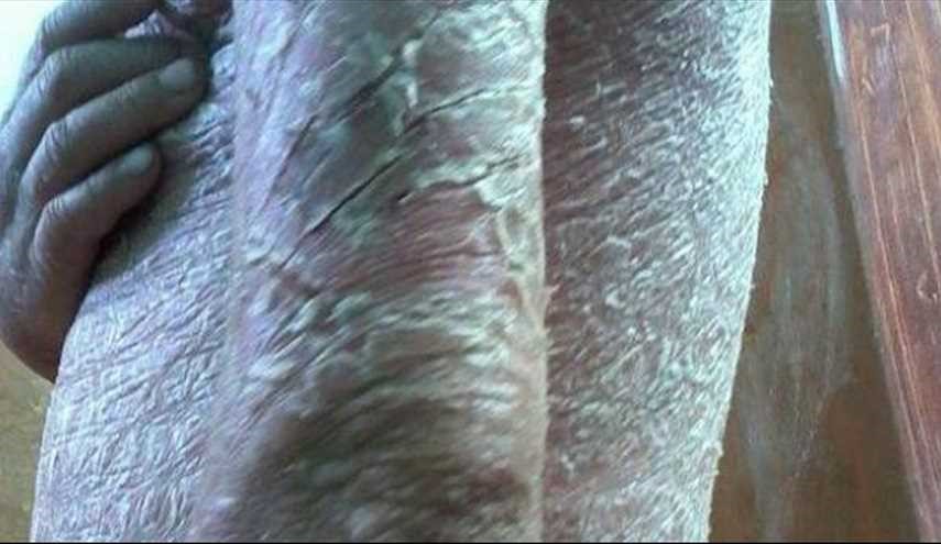 تفشى في دولة عربية.. ما هو هذا المرض الذي يصعب علاجه؟