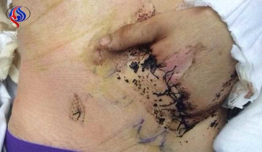 أطباء ينقذون يد مريض بخياطتها داخل بطنه!