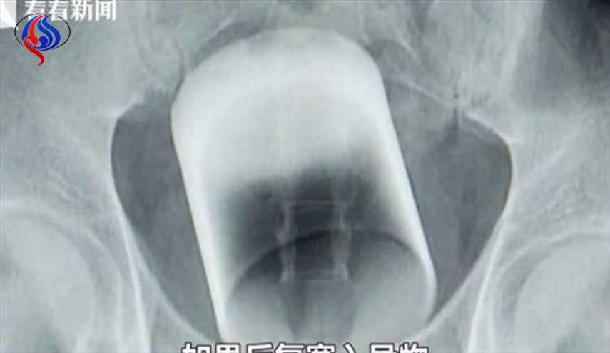 أطباء يكتشفون كأساً زجاجياً داخل أمعاء رجل!