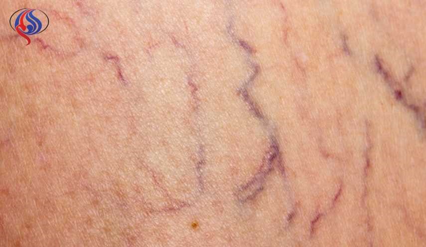 زيت النعناع علاج فعال للتخفيف من دوالي الساقين