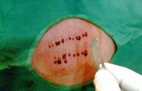 حجامت سرطان را درمان می کند؟! / هشدار درباره حجامت های زیر زمینی