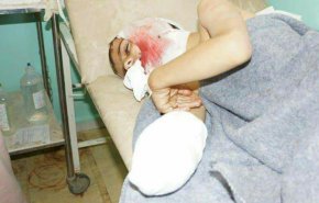 شاهد بالصور.. قنبلة عنقودية تقطع اوصال اطفال بصعدة