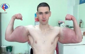 حقن السينثول لتضخيم عضلاته.. فكاد يفقد ذراعيه!