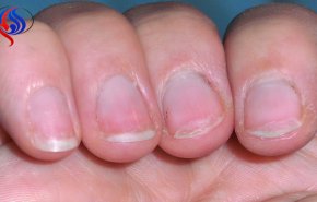 5 طرق بسيطة للتخلص من هشاشة الأظافر