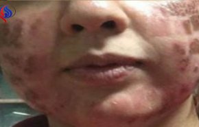 ذهبت لمركز تجميل استعداداً لزفافها.. فخرجت مشوهة وبعاهة مستديمة!