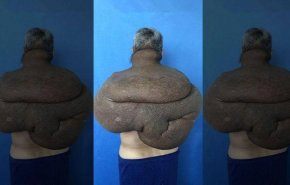 بالصور.. 33 ساعة لإنقاذ رجل من ورم سرطاني وزنه 28 كيلوغراما