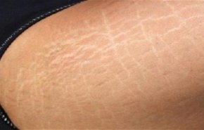 حلول بسيطة للتخلص من ترهلات الجلد بدون عمليات التجميل