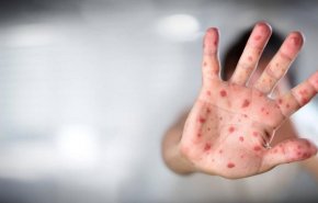 شیوع آبله میمون در ۱۲ کشور؛ سازمان جهانی بهداشت درباره افزایش شیوع هشدار داد