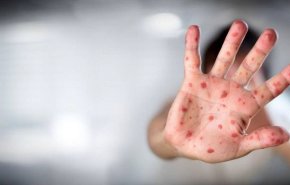 در صورتی که مشکوک به آبله میمونی شدیم چکار کنیم؟
