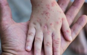 نيويورك تبلّغ عن أول حالة إصابة بجدري القردة لدى قاصر