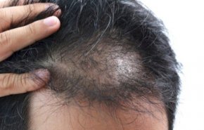 7 معلومات يمكن أن تكشفها حالة شعرك عن صحتك
