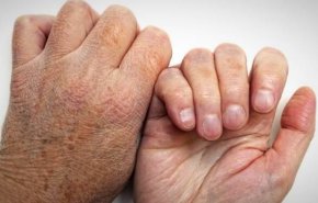 شناسایی بیش از ۱۱ هزار بیمار مبتلا به جذام در کشور/ جان باختن ۲ هزار و ۵۰۳ بیمار 