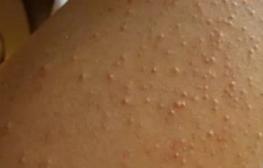 بیماران مبتلا به سلیاک در غزه با مرگ روبرو هستند