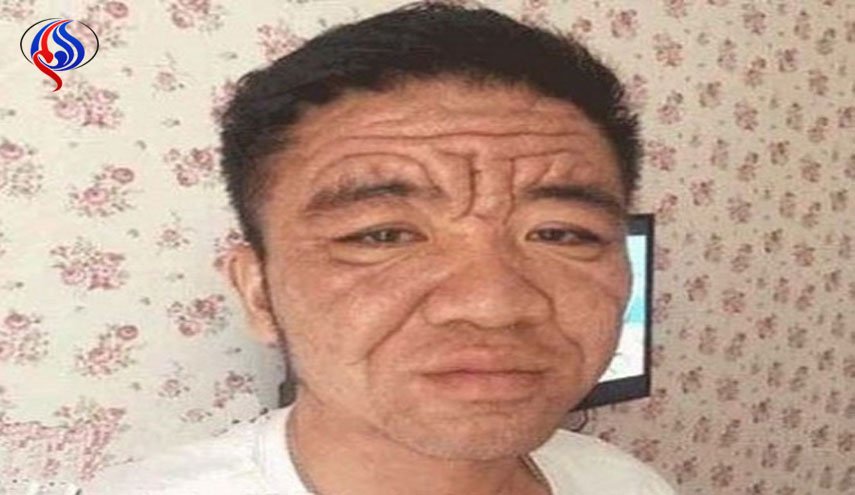 مرد 30 ساله ای که ناگهان 80 ساله شد! + تصاویر