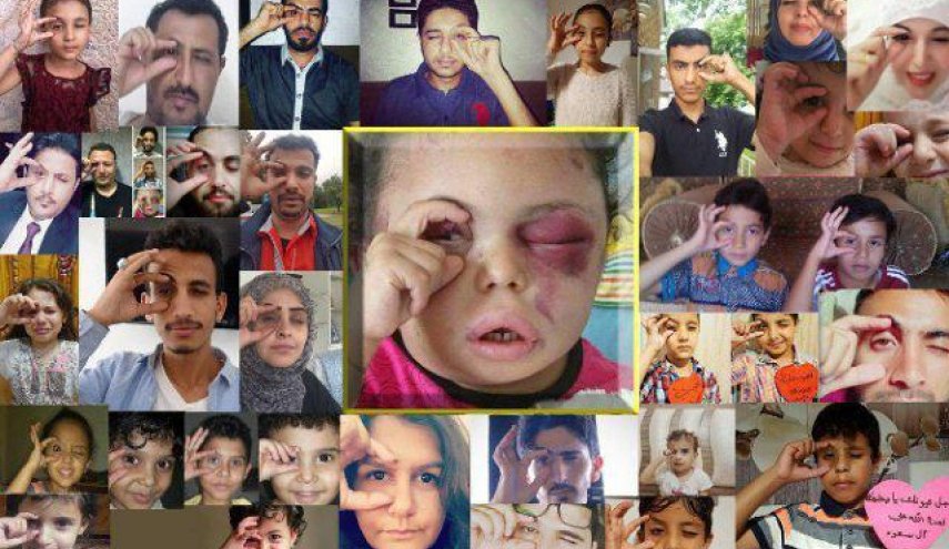 همدردی جهانی در شبکه های اجتماعی با دختر بچه یمنی+تصاویر