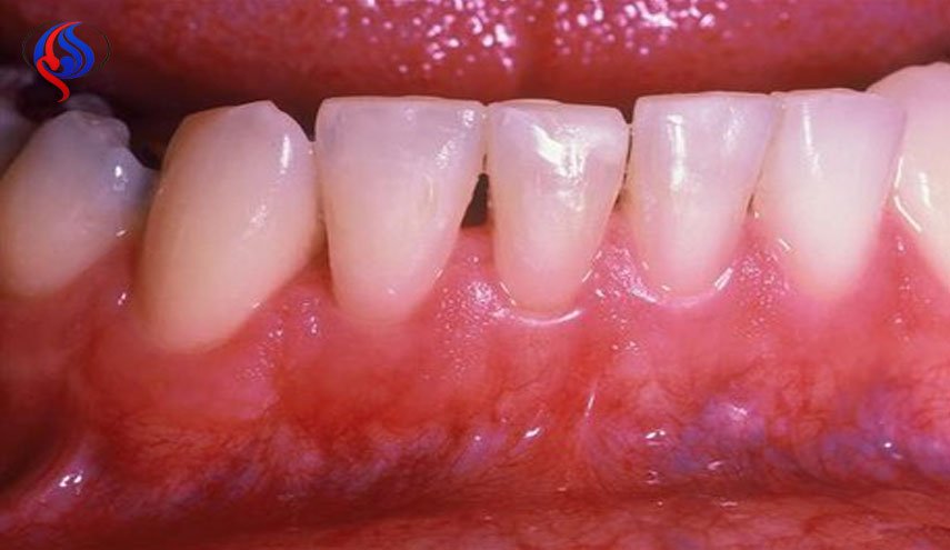 ارتباط بیماری لثه با سرطان مری