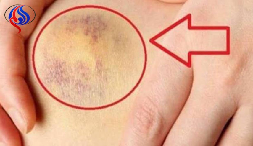 إياكم أن تتجاهلوا هذه الكدمات.. فهي مؤشر خطير!
