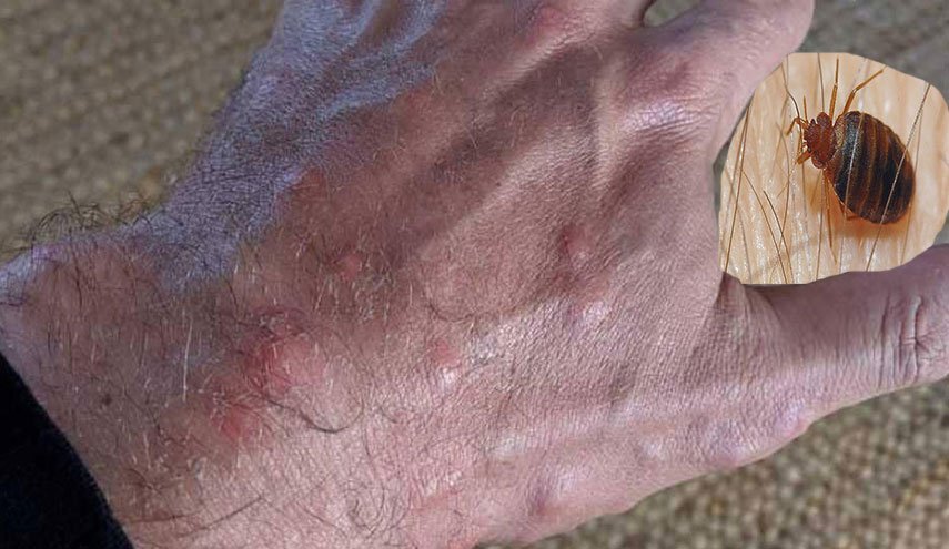 120 لسعة لمسافر على درجة رجال الأعمال.. والشركة تعتذر!!