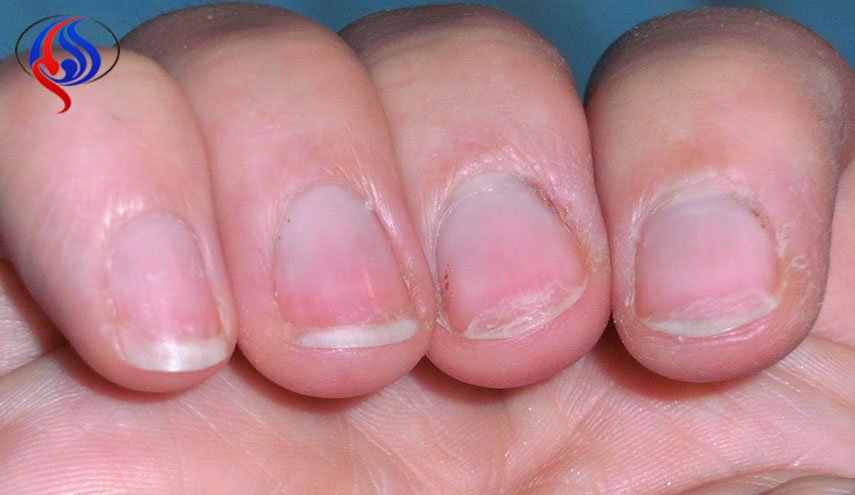 5 طرق بسيطة للتخلص من هشاشة الأظافر