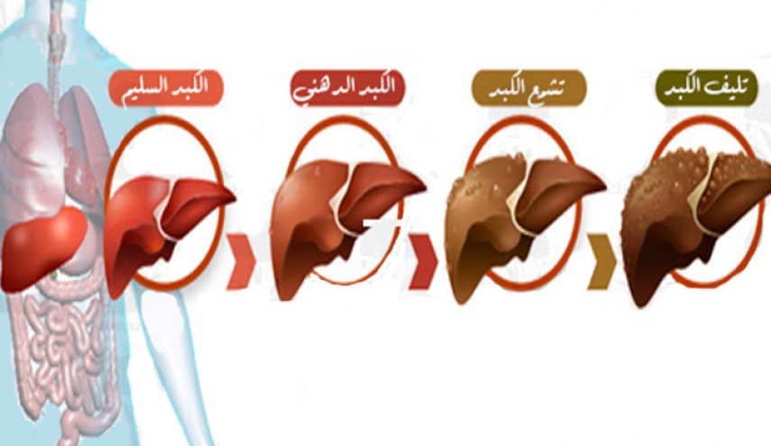 أعراض مرض الكبد وتأكيد امتلاء الكبد بالسموم!