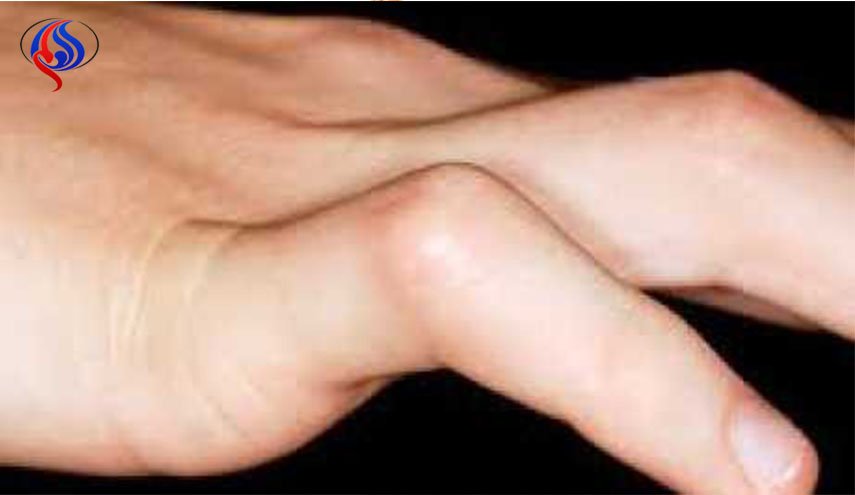 سيدة تعثر على إصبع رجل في علبة دجاج مجمد 