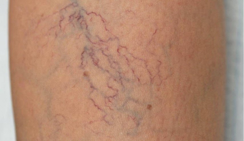 4 نصائح تضمن لك الوقاية من دوالي الساقين