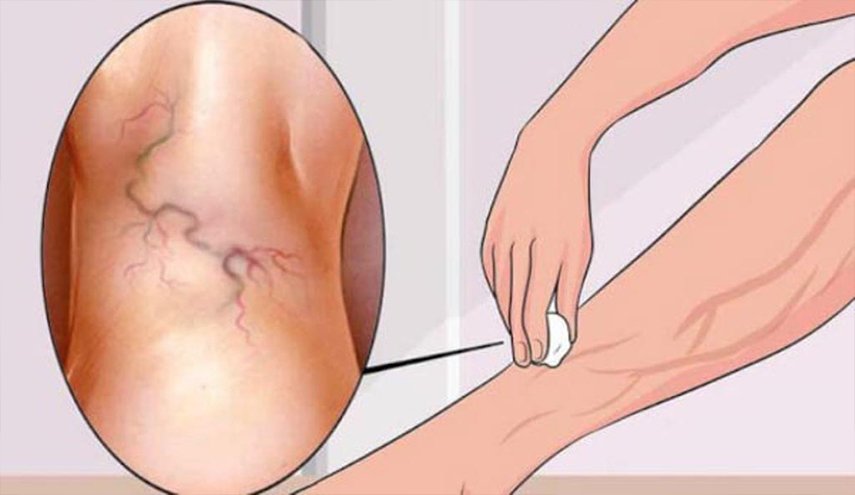 دوالي الساقين.. الأسباب وأفضل سبل العلاج 