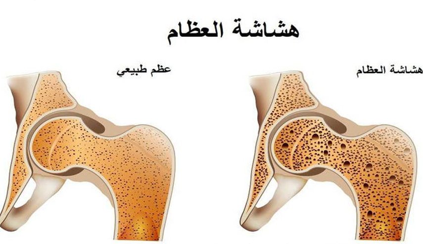 هذه الاطعمة تقي من هشاشة العظام، فلا تهملوها!