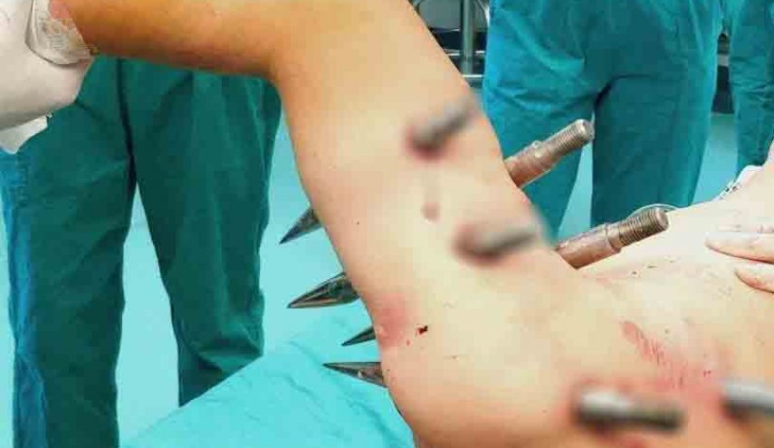 نجاة عامل بأعجوبة بعدما طعنته آلة بـ 10 قضبان حديدية