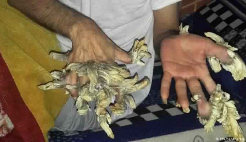 بعد خضوعه لـ25 عملية جراحية.. 'رجل الشجرة' يطلب قطع يديه