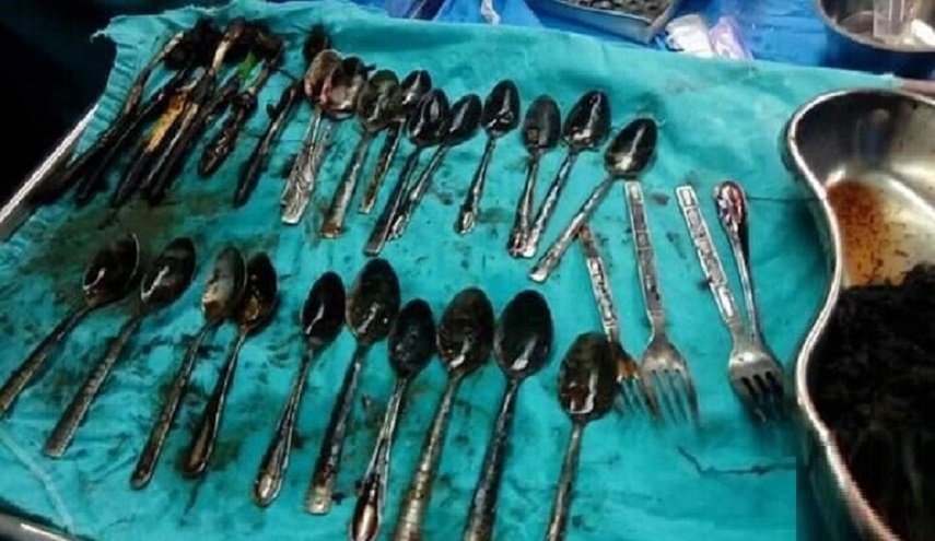استخراج عدد كبير من الملاعق من معدة مصري