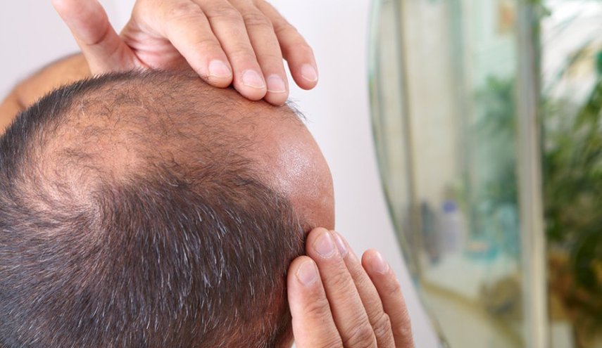ساعات العمل الطويلة تزيد من إصابة الرجال بالصلع