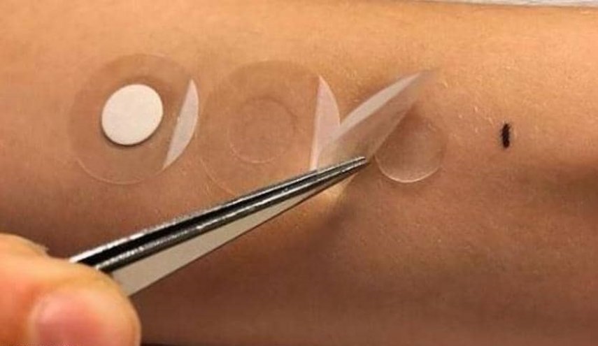 أداة جديدة للتعرف على صلة الشامة بالسرطان