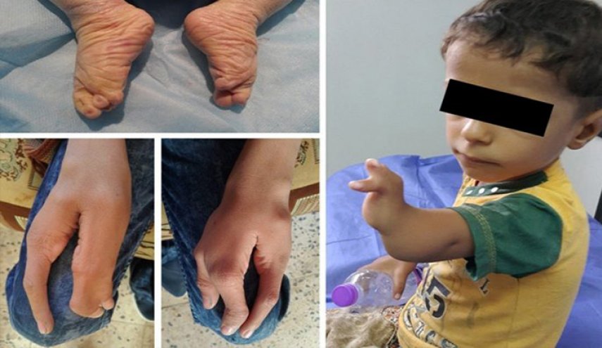 تشوهات خَلقيّة مروّعة لدى أطفال عراقيين ولدوا قرب قاعدة أمريكية