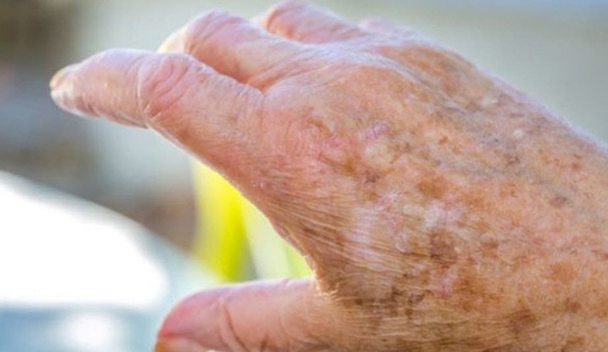 علاج البقع الداكنة أصبح أسهل وأسرع