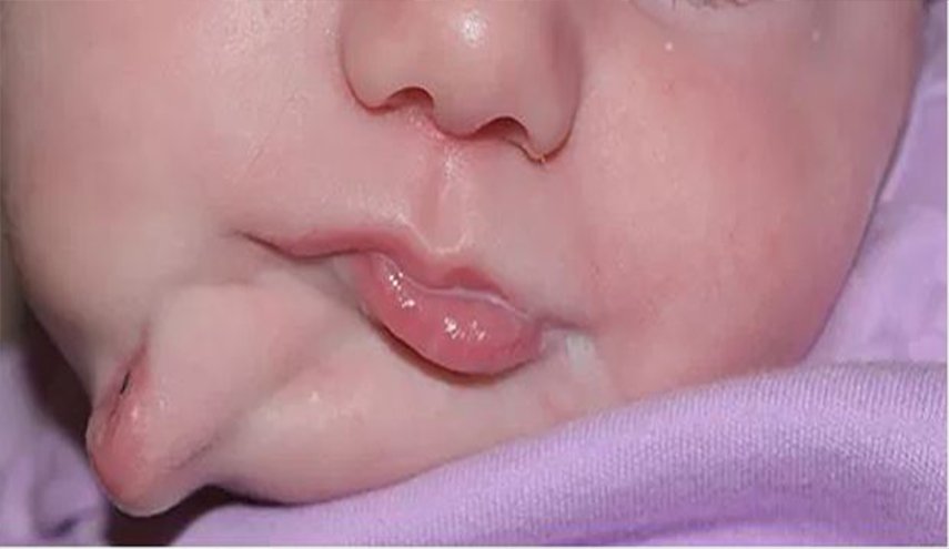 طفلة بفمين منفصلين تخضع لعملية اصلاح