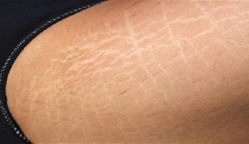 حلول بسيطة للتخلص من ترهلات الجلد بدون عمليات التجميل