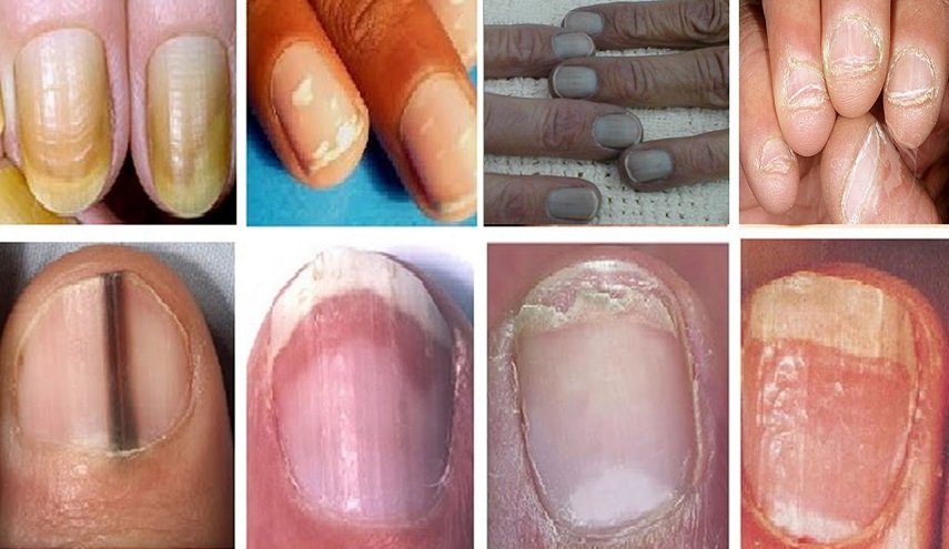 معاينة الأظافر تساعد على تشخيص 'السرطان'!